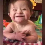 Down Syndrome Baby